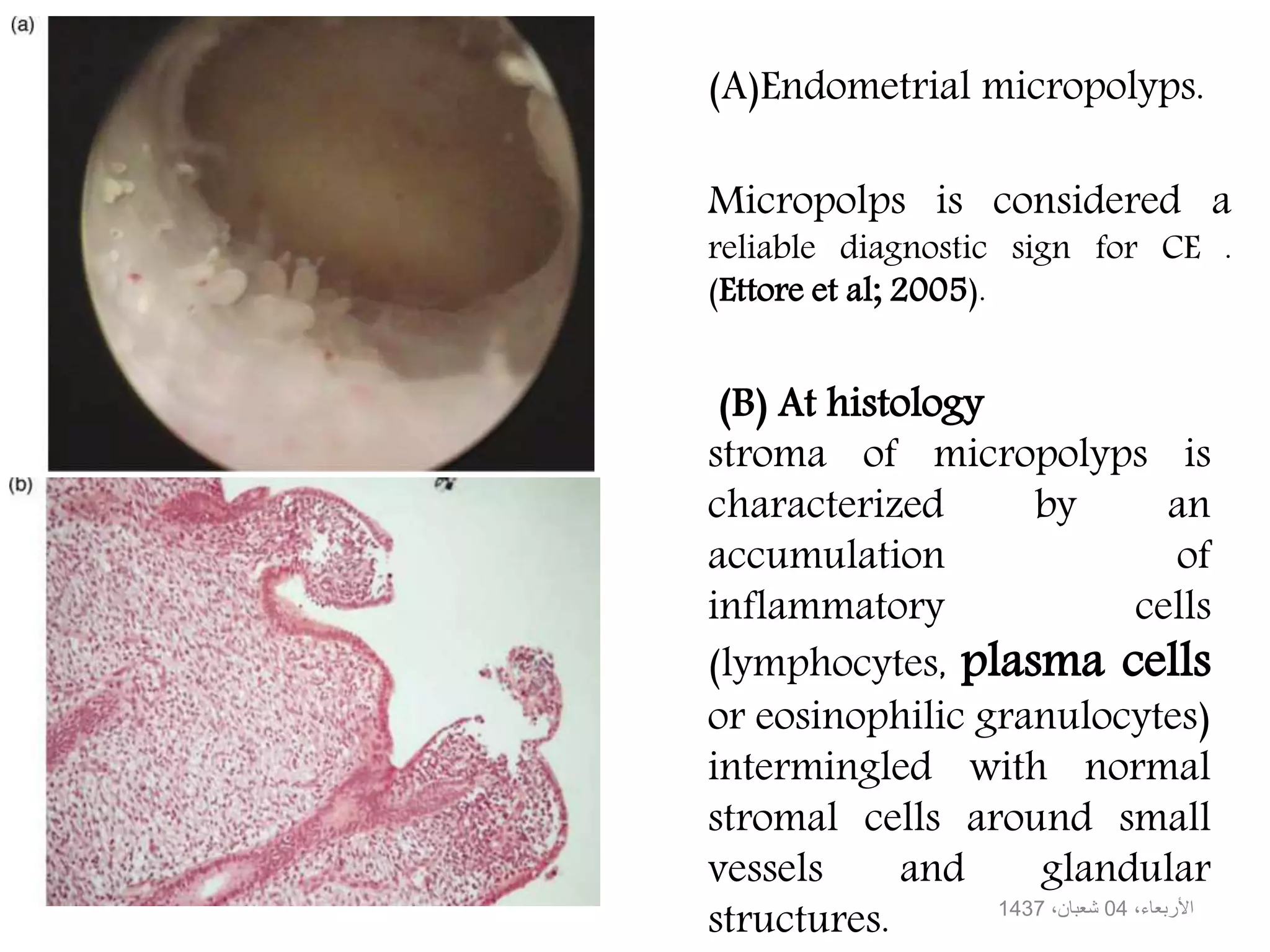 (B) At histology
stroma of micropolyps is
characterized by an
accumulation of
inflammatory cells
(lymphocytes, plasma cells
or eosinophilic granulocytes)
intermingled with normal
stromal cells around small
vessels and glandular
structures.
(A)Endometrial micropolyps.
Micropolps is considered a
reliable diagnostic sign for CE .
(Ettore et al; 2005).
،األربعاء04،شعبان1437
