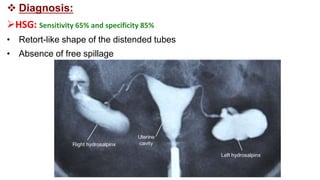  Diagnosis:
HSG: Sensitivity 65% and specificity 85%
• Retort-like shape of the distended tubes
• Absence of free spillage
 