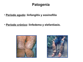 Linfangitis Reticular IV Filarias .ppt