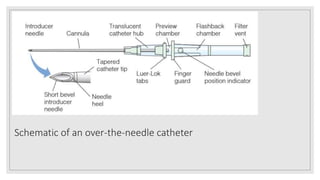 Schematic of an over-the-needle catheter
 