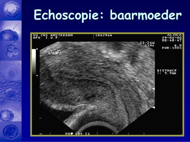 Ivf voorlichtingsavond2014slideshare