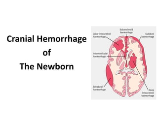 Cranial Hemorrhage
of
The Newborn
 
