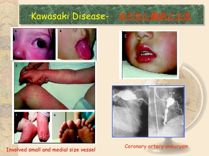Ivig Resistent In Kawasaki Disease By Ho Chang Kuo (郭和昌)川崎症