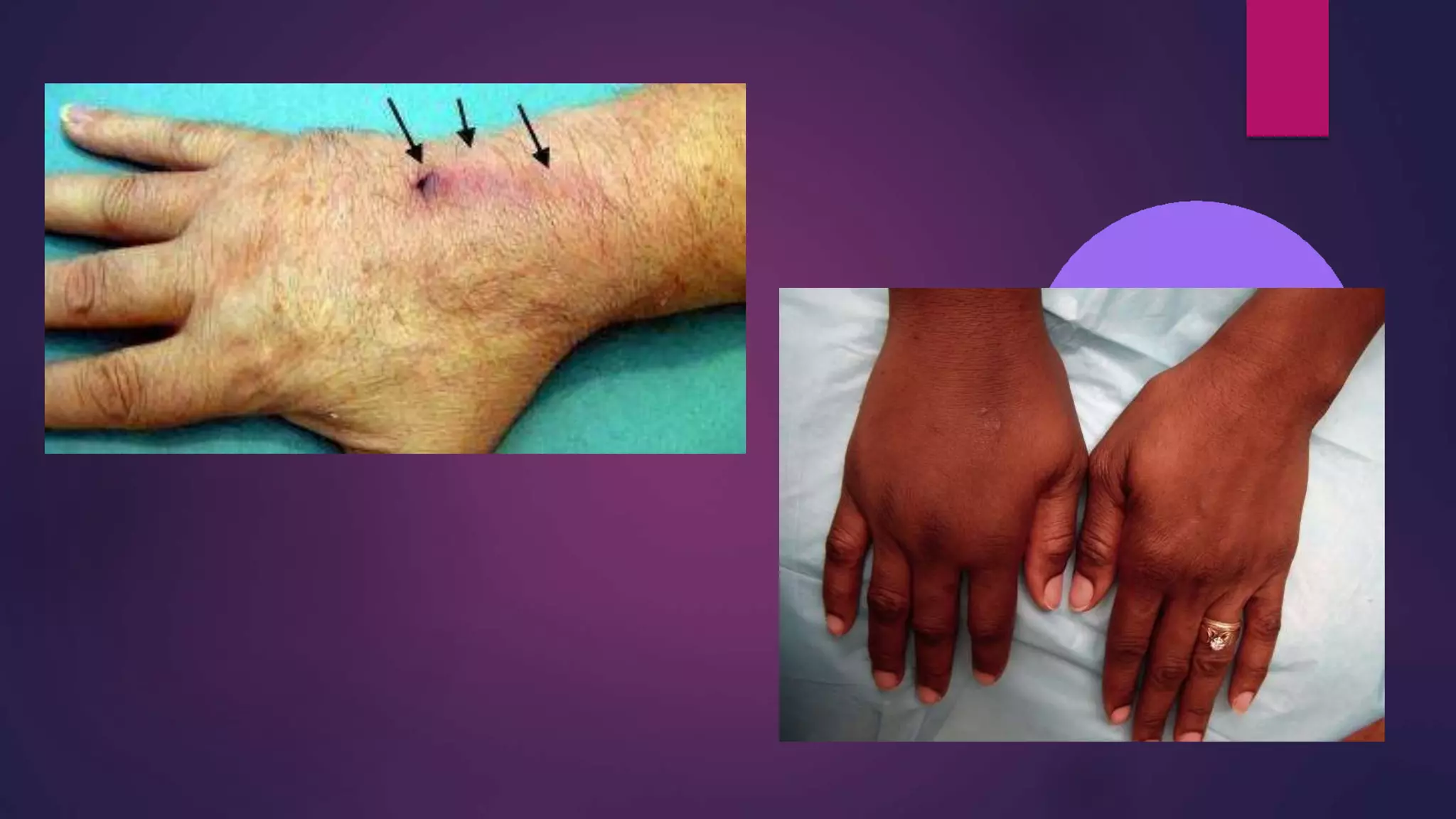 IV infiltration and Extravasation | PPTX