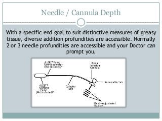 Needle / Cannula Depth
With a specific end goal to suit distinctive measures of greasy
tissue, diverse addition profundities are accessible. Normally
2 or 3 needle profundities are accessible and your Doctor can
prompt you.
 