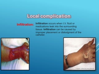 Local complication
Infiltration: Infiltration occurs when I.V. fluid or
medications leak into the surrounding
tissue. Infiltration can be caused by
improper placement or dislodgment of the
catheter.
 