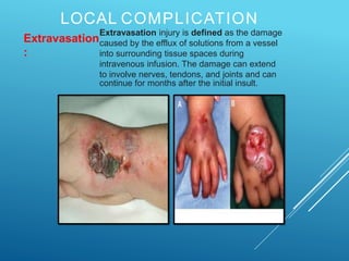 LOCAL COMPLICATION
Extravasation
:
Extravasation injury is defined as the damage
caused by the efflux of solutions from a vessel
into surrounding tissue spaces during
intravenous infusion. The damage can extend
to involve nerves, tendons, and joints and can
continue for months after the initial insult.
 