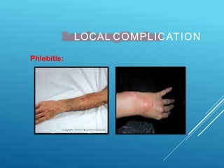 LOCAL COMPLICATION
Phlebitis:
 
