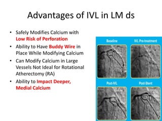 Advantages of IVL in LM ds
• Safely Modifies Calcium with
Low Risk of Perforation
• Ability to Have Buddy Wire in
Place While Modifying Calcium
• Can Modify Calcium in Large
Vessels Not Ideal for Rotational
Atherectomy (RA)
• Ability to Impact Deeper,
Medial Calcium
 
