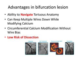 Advantages in bifurcation lesion
• Ability to Navigate Tortuous Anatomy
• Can Keep Multiple Wires Down While
Modifying Calcium
• Circumferential Calcium Modification Without
Wire Bias
• Low Risk of Dissection
 