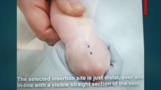 Iv line insertion in children | PPTX