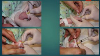 Iv Line Baby Iv line insertion in children | PPTX