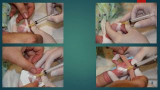 Iv Line Inlet Iv line insertion in children | PPTX