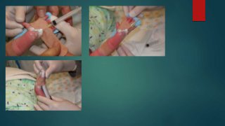 Iv Line Tracing Iv line insertion in children | PPTX