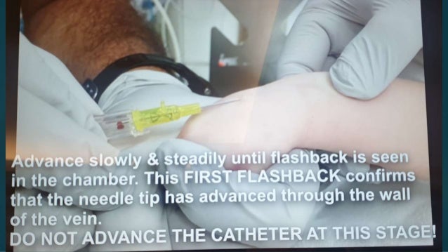 Iv Line Tracing Iv line insertion in children | PPTX