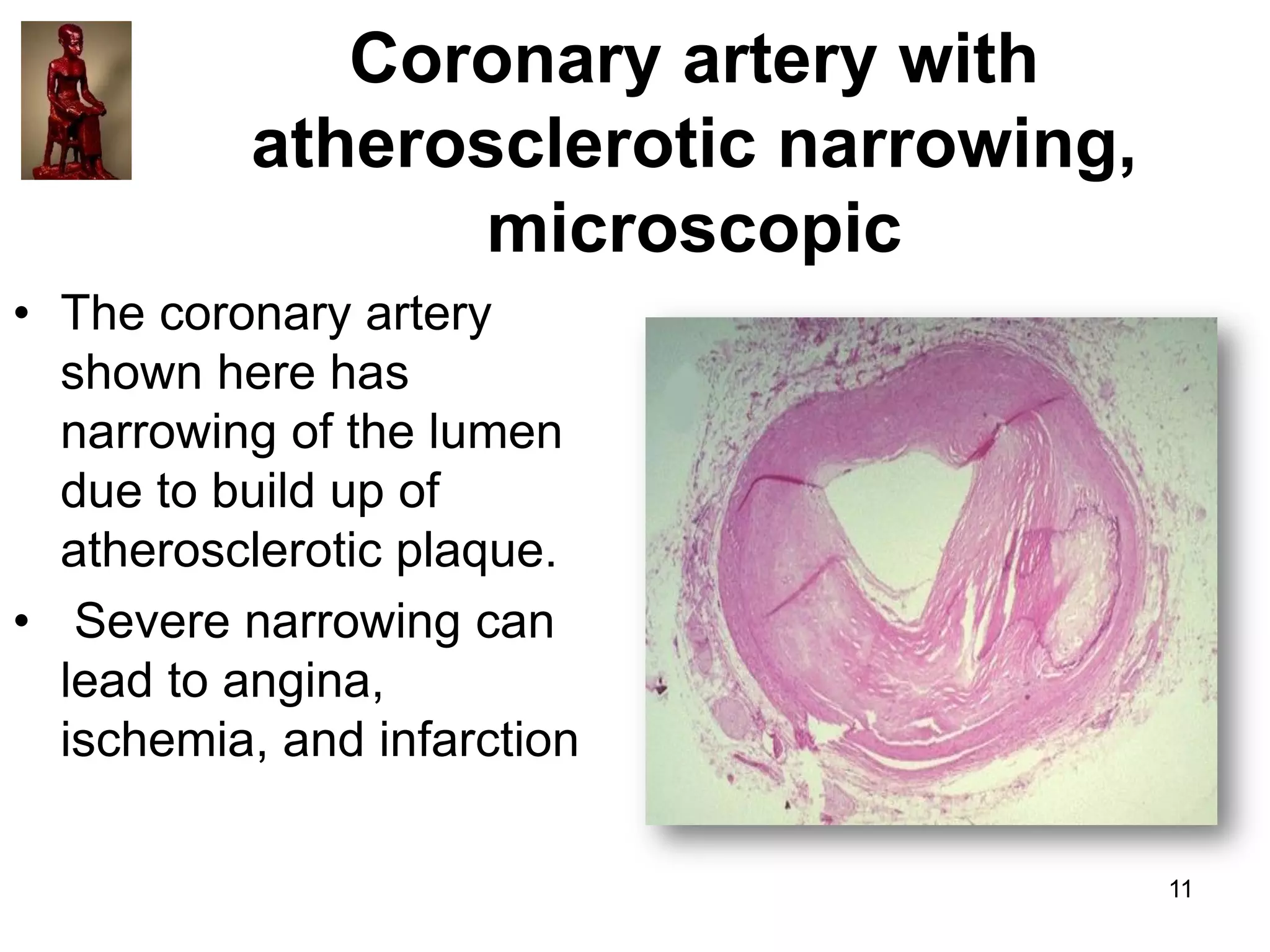 Coronary artery with
atherosclerotic narrowing,
microscopic
• The coronary artery
shown here has
narrowing of the lumen
due to build up of
atherosclerotic plaque.
• Severe narrowing can
lead to angina,
ischemia, and infarction
11

 
