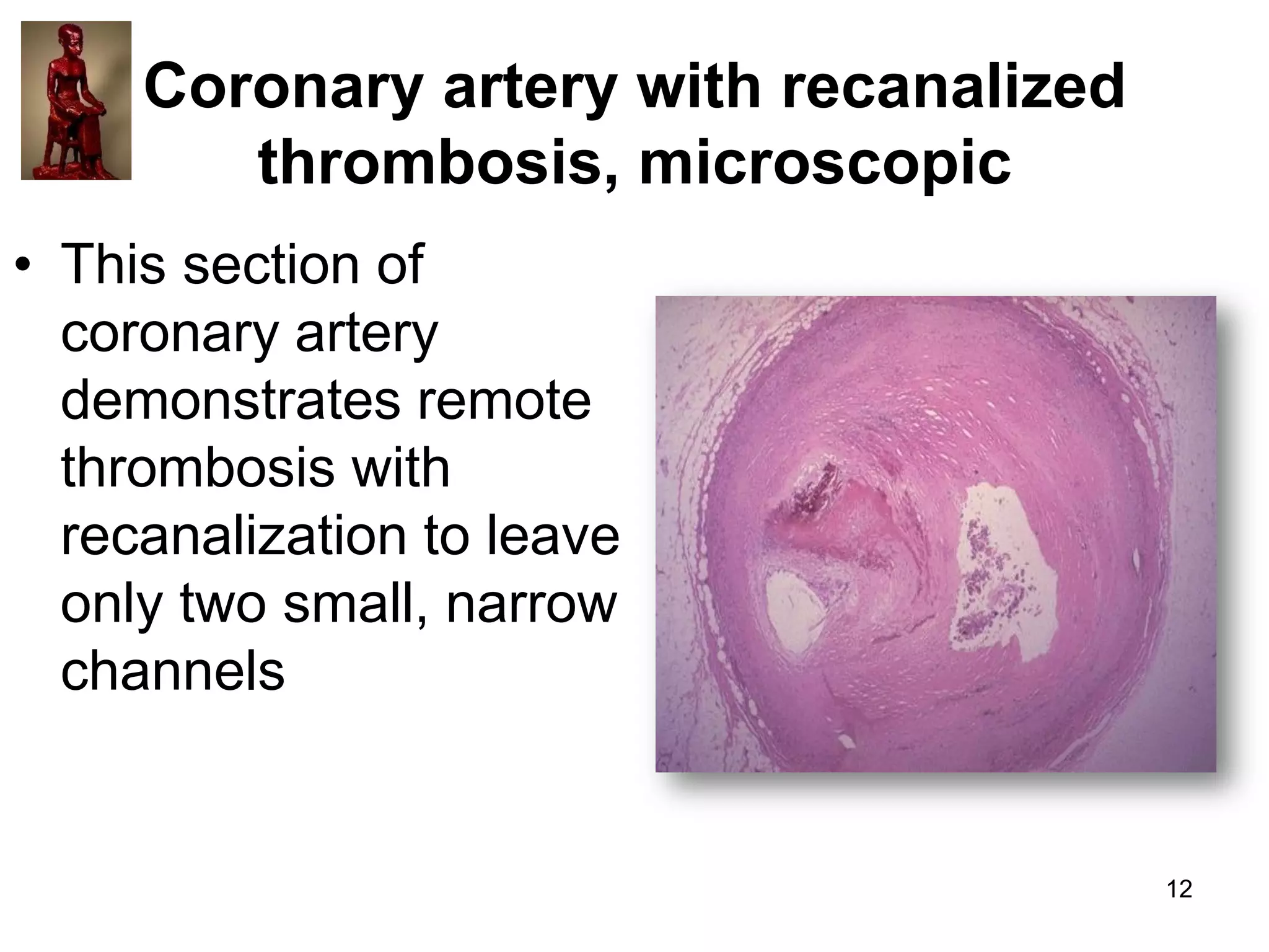 Coronary artery with recanalized
thrombosis, microscopic
• This section of
coronary artery
demonstrates remote
thrombosis with
recanalization to leave
only two small, narrow
channels

12

 