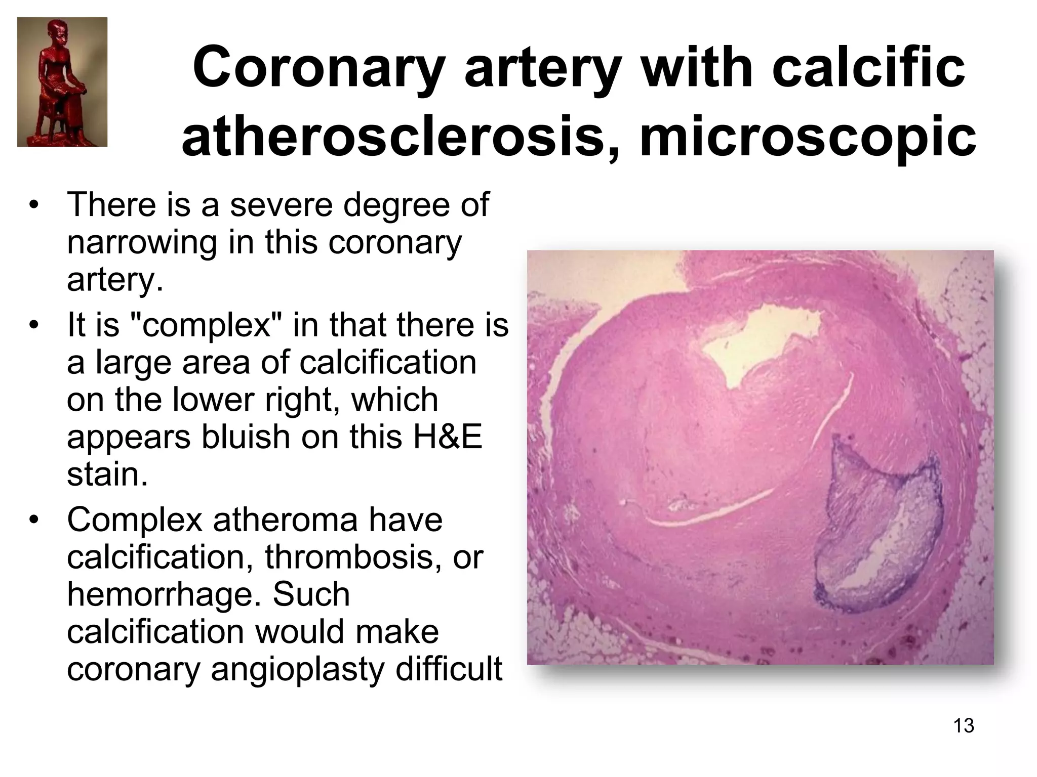 Coronary artery with calcific
atherosclerosis, microscopic
• There is a severe degree of
narrowing in this coronary
artery.
• It is "complex" in that there is
a large area of calcification
on the lower right, which
appears bluish on this H&E
stain.
• Complex atheroma have
calcification, thrombosis, or
hemorrhage. Such
calcification would make
coronary angioplasty difficult
13

 