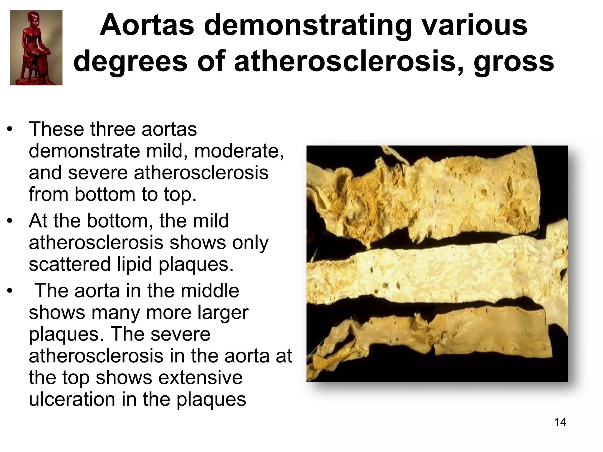 Aortas demonstrating various
degrees of atherosclerosis, gross
• These three aortas
demonstrate mild, moderate,
and severe atherosclerosis
from bottom to top.
• At the bottom, the mild
atherosclerosis shows only
scattered lipid plaques.
• The aorta in the middle
shows many more larger
plaques. The severe
atherosclerosis in the aorta at
the top shows extensive
ulceration in the plaques
14

 