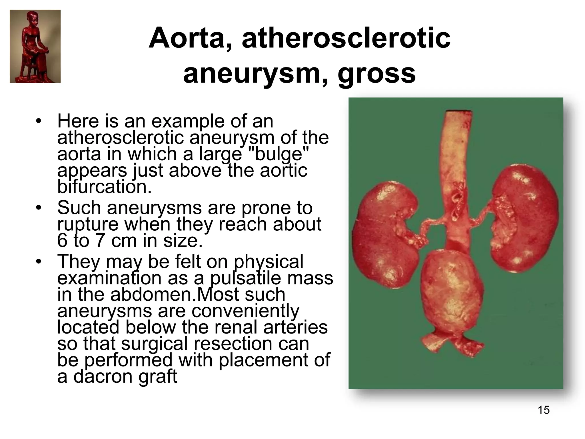 Aorta, atherosclerotic
aneurysm, gross
• Here is an example of an
atherosclerotic aneurysm of the
aorta in which a large "bulge"
appears just above the aortic
bifurcation.
• Such aneurysms are prone to
rupture when they reach about
6 to 7 cm in size.
• They may be felt on physical
examination as a pulsatile mass
in the abdomen.Most such
aneurysms are conveniently
located below the renal arteries
so that surgical resection can
be performed with placement of
a dacron graft
15

 