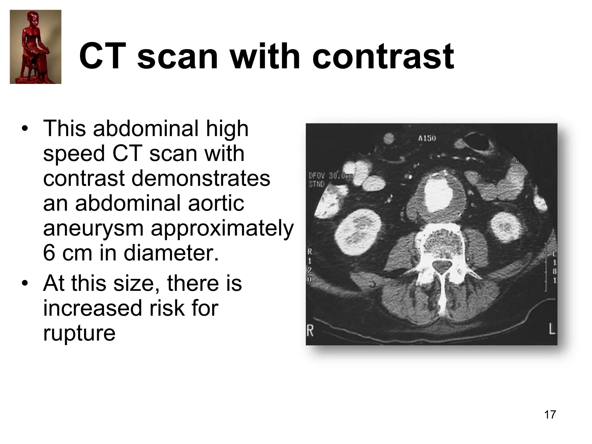 CT scan with contrast
• This abdominal high
speed CT scan with
contrast demonstrates
an abdominal aortic
aneurysm approximately
6 cm in diameter.
• At this size, there is
increased risk for
rupture

17

 