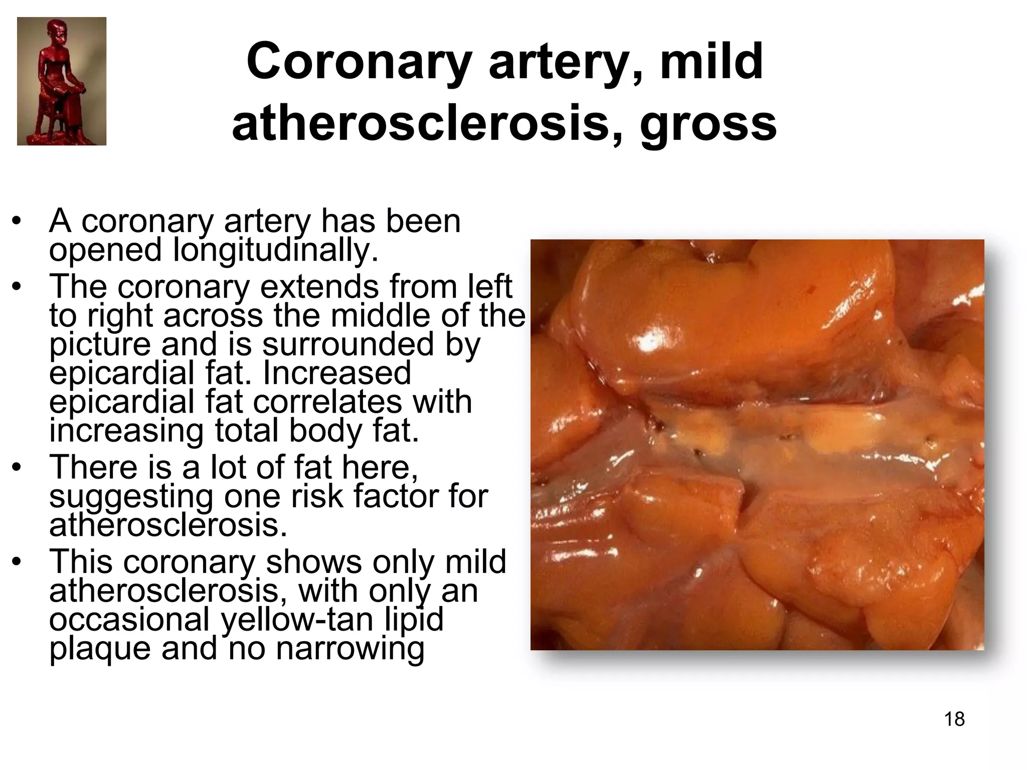 Coronary artery, mild
atherosclerosis, gross
• A coronary artery has been
opened longitudinally.
• The coronary extends from left
to right across the middle of the
picture and is surrounded by
epicardial fat. Increased
epicardial fat correlates with
increasing total body fat.
• There is a lot of fat here,
suggesting one risk factor for
atherosclerosis.
• This coronary shows only mild
atherosclerosis, with only an
occasional yellow-tan lipid
plaque and no narrowing
18

 