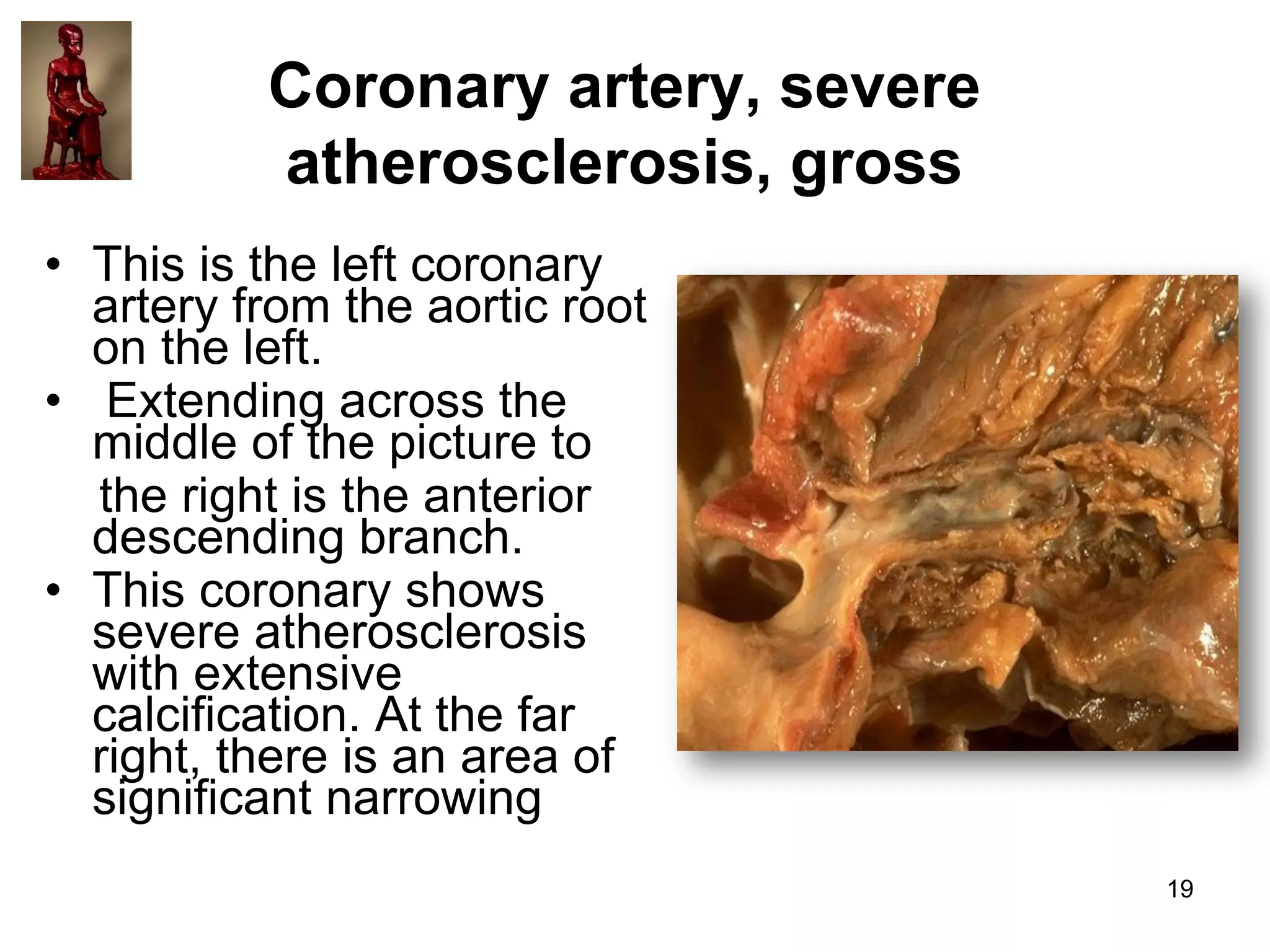 Coronary artery, severe
atherosclerosis, gross
• This is the left coronary
artery from the aortic root
on the left.
• Extending across the
middle of the picture to
the right is the anterior
descending branch.
• This coronary shows
severe atherosclerosis
with extensive
calcification. At the far
right, there is an area of
significant narrowing
19

 