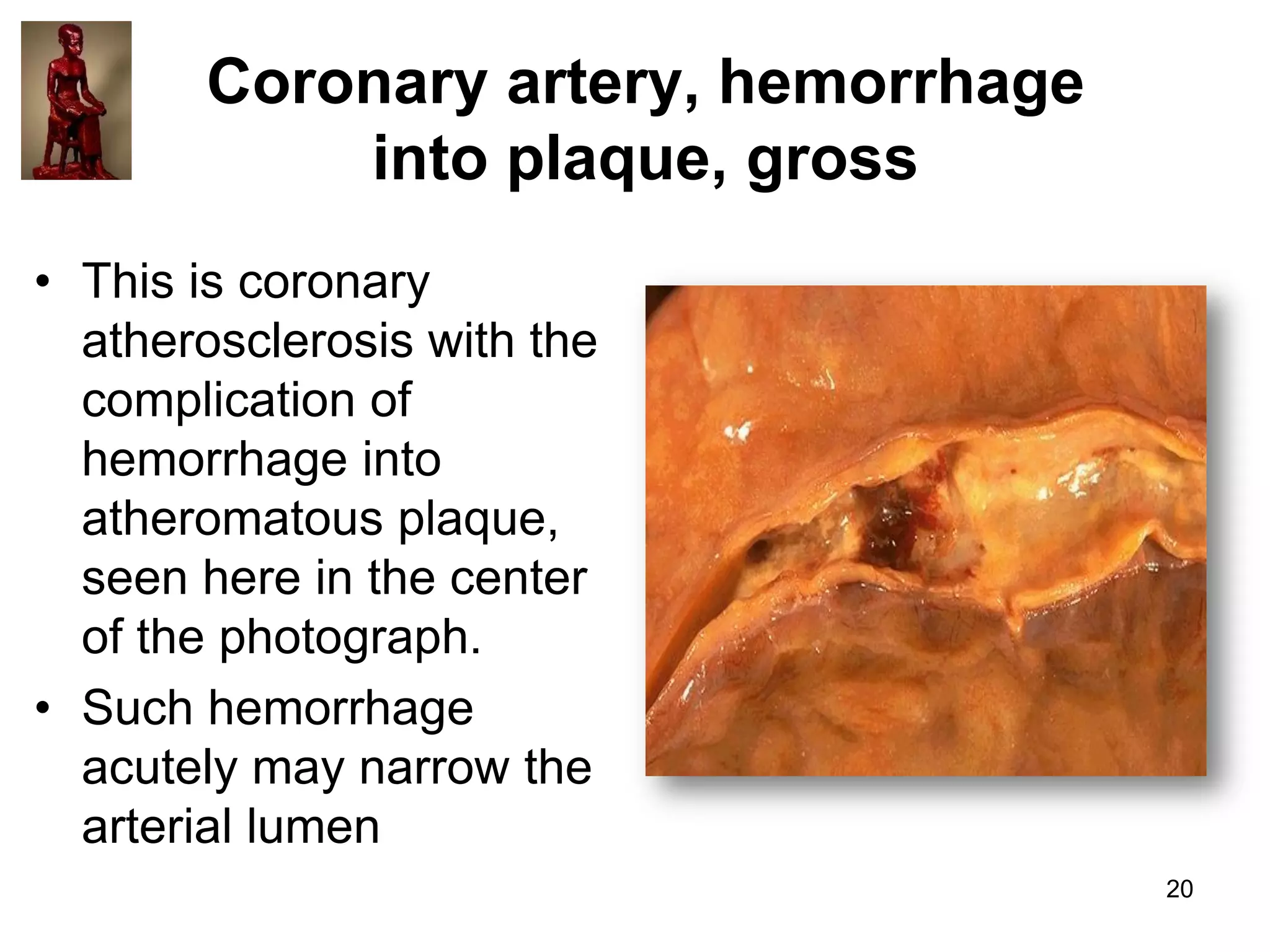 Coronary artery, hemorrhage
into plaque, gross
• This is coronary
atherosclerosis with the
complication of
hemorrhage into
atheromatous plaque,
seen here in the center
of the photograph.
• Such hemorrhage
acutely may narrow the
arterial lumen
20

 