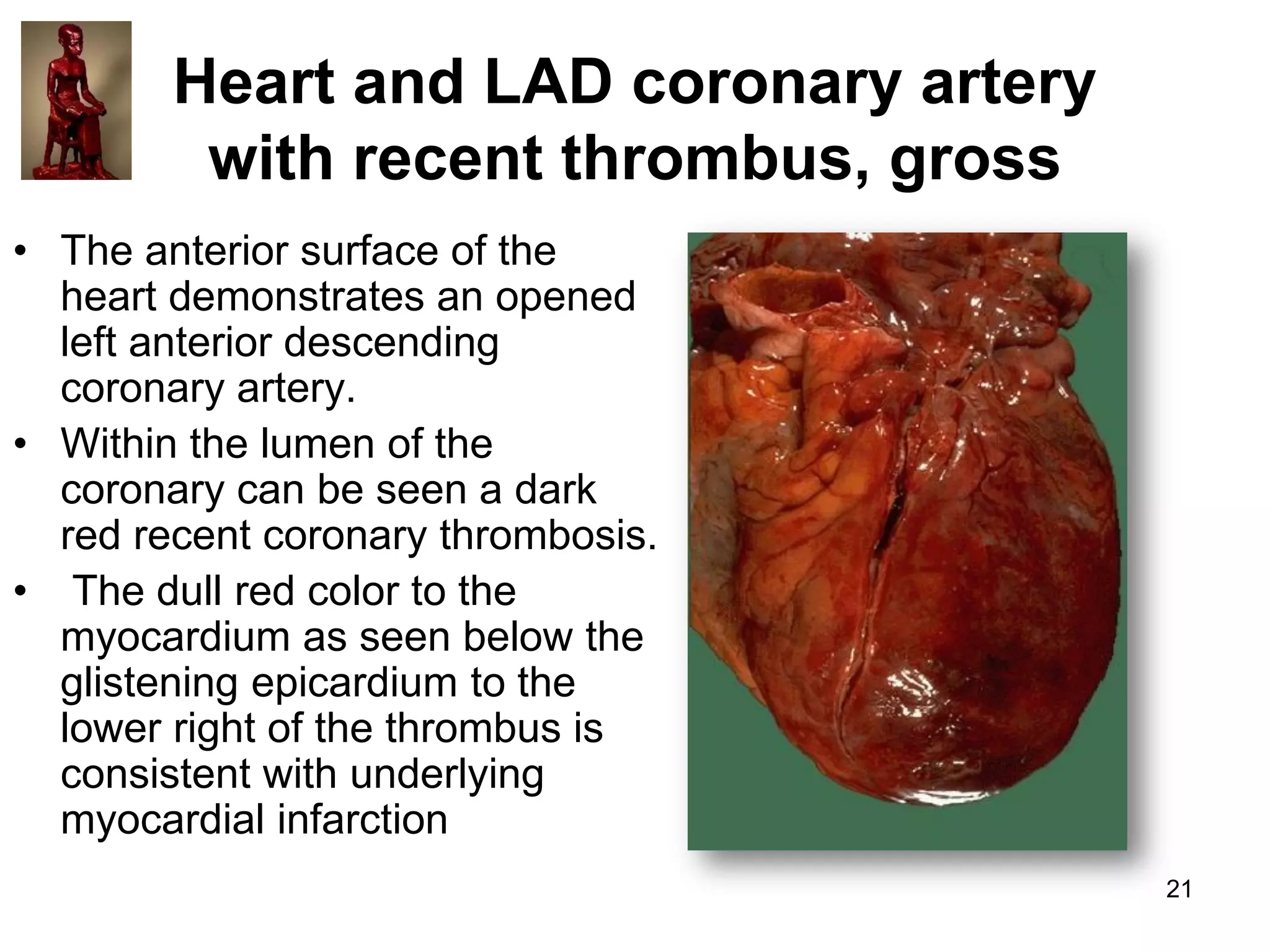 Heart and LAD coronary artery
with recent thrombus, gross
• The anterior surface of the
heart demonstrates an opened
left anterior descending
coronary artery.
• Within the lumen of the
coronary can be seen a dark
red recent coronary thrombosis.
• The dull red color to the
myocardium as seen below the
glistening epicardium to the
lower right of the thrombus is
consistent with underlying
myocardial infarction
21

 