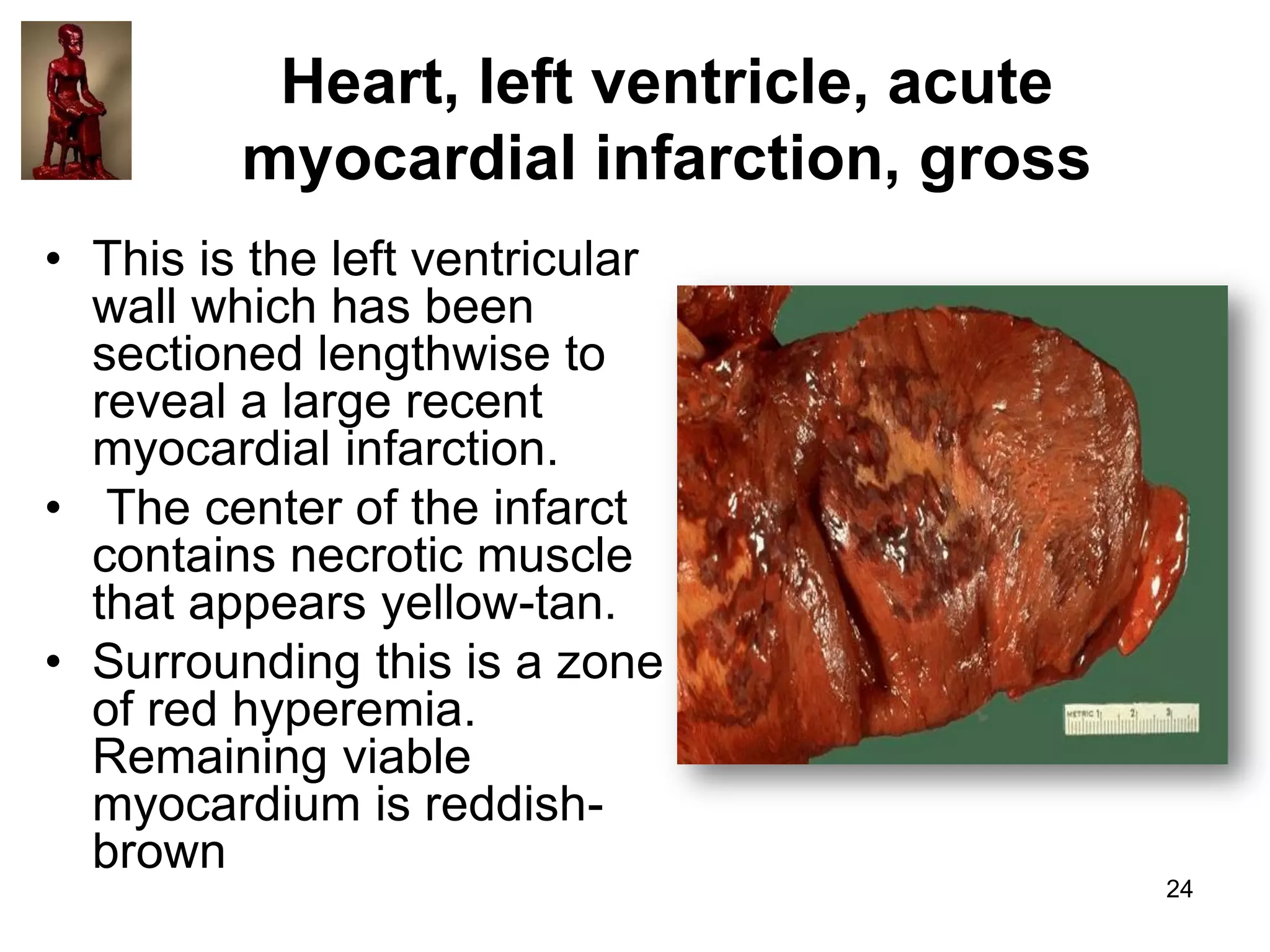 Heart, left ventricle, acute
myocardial infarction, gross
• This is the left ventricular
wall which has been
sectioned lengthwise to
reveal a large recent
myocardial infarction.
• The center of the infarct
contains necrotic muscle
that appears yellow-tan.
• Surrounding this is a zone
of red hyperemia.
Remaining viable
myocardium is reddishbrown
24

 