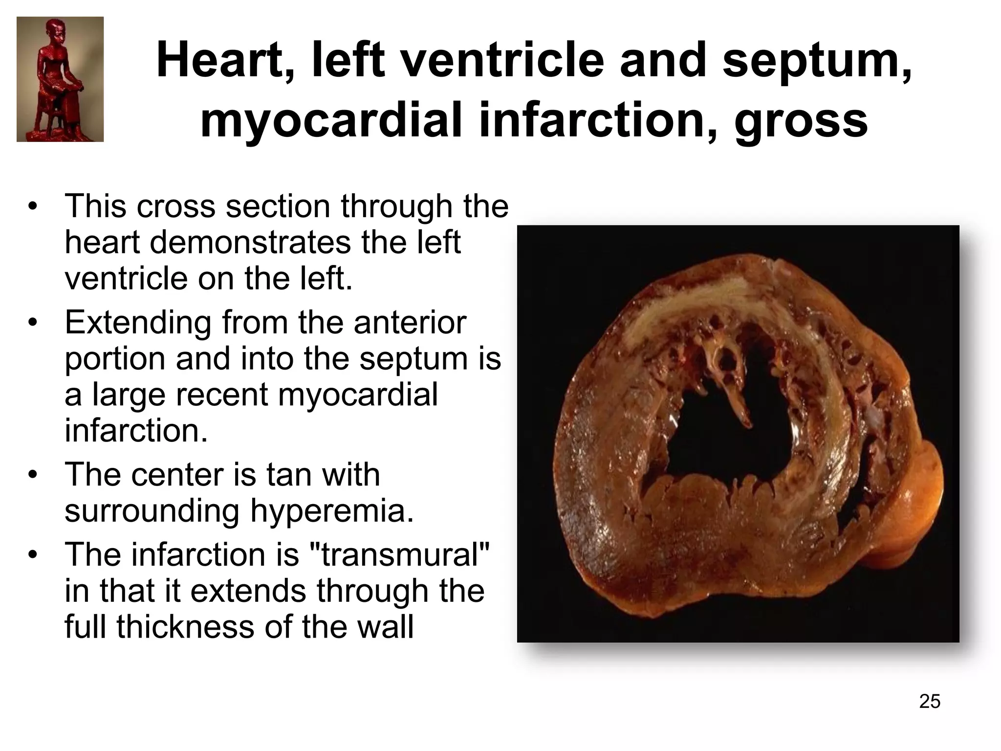 Heart, left ventricle and septum,
myocardial infarction, gross
• This cross section through the
heart demonstrates the left
ventricle on the left.
• Extending from the anterior
portion and into the septum is
a large recent myocardial
infarction.
• The center is tan with
surrounding hyperemia.
• The infarction is "transmural"
in that it extends through the
full thickness of the wall
25

 