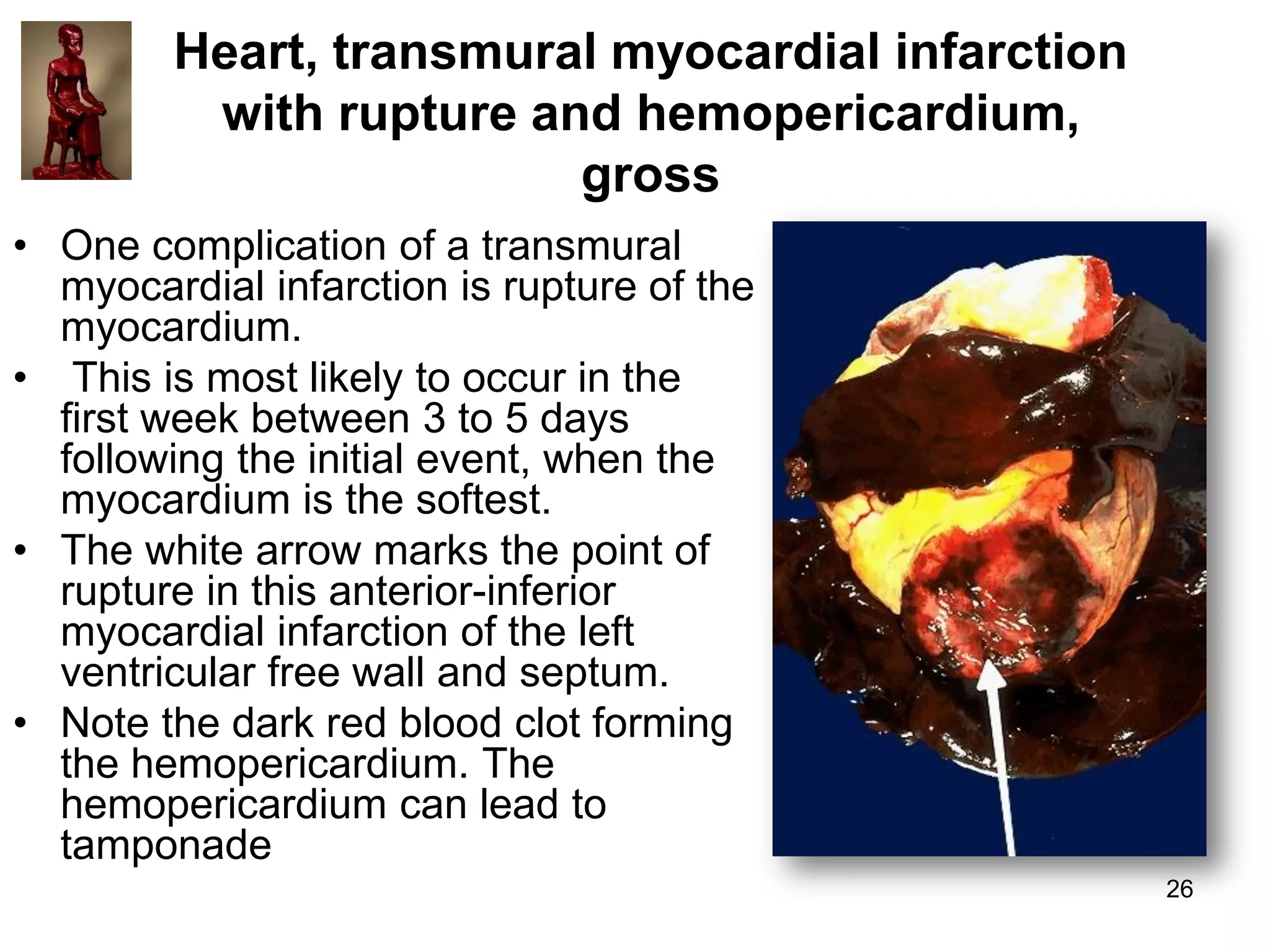 Heart, transmural myocardial infarction
with rupture and hemopericardium,
gross
• One complication of a transmural
myocardial infarction is rupture of the
myocardium.
• This is most likely to occur in the
first week between 3 to 5 days
following the initial event, when the
myocardium is the softest.
• The white arrow marks the point of
rupture in this anterior-inferior
myocardial infarction of the left
ventricular free wall and septum.
• Note the dark red blood clot forming
the hemopericardium. The
hemopericardium can lead to
tamponade
26

 