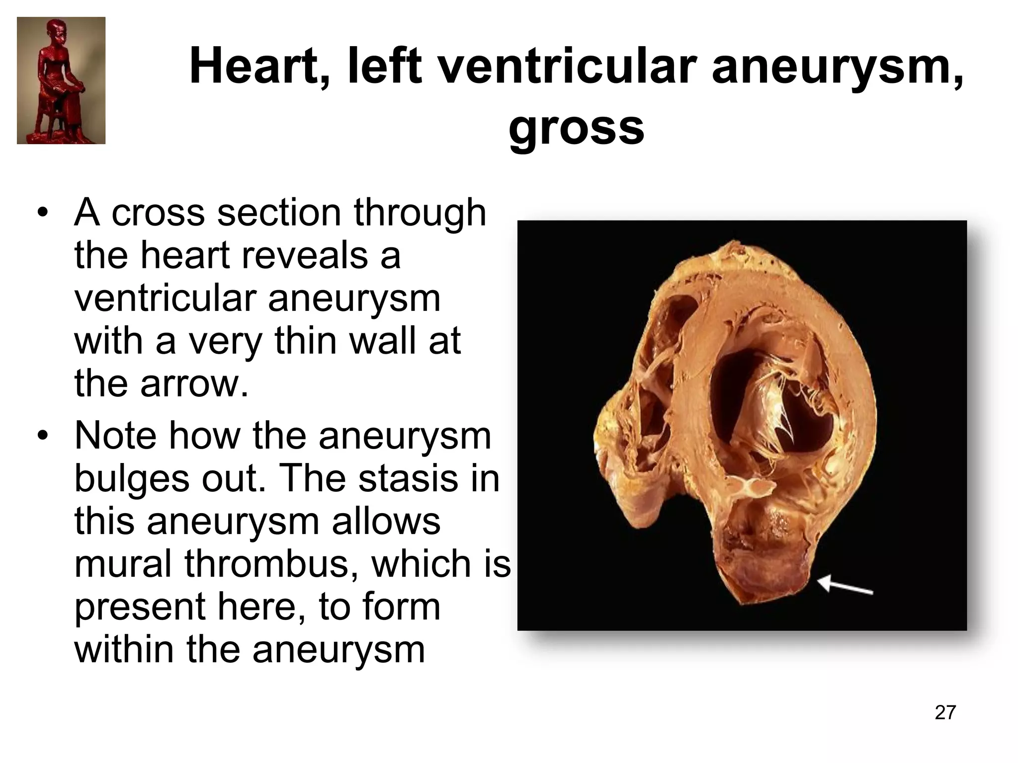 Heart, left ventricular aneurysm,
gross
• A cross section through
the heart reveals a
ventricular aneurysm
with a very thin wall at
the arrow.
• Note how the aneurysm
bulges out. The stasis in
this aneurysm allows
mural thrombus, which is
present here, to form
within the aneurysm
27

 