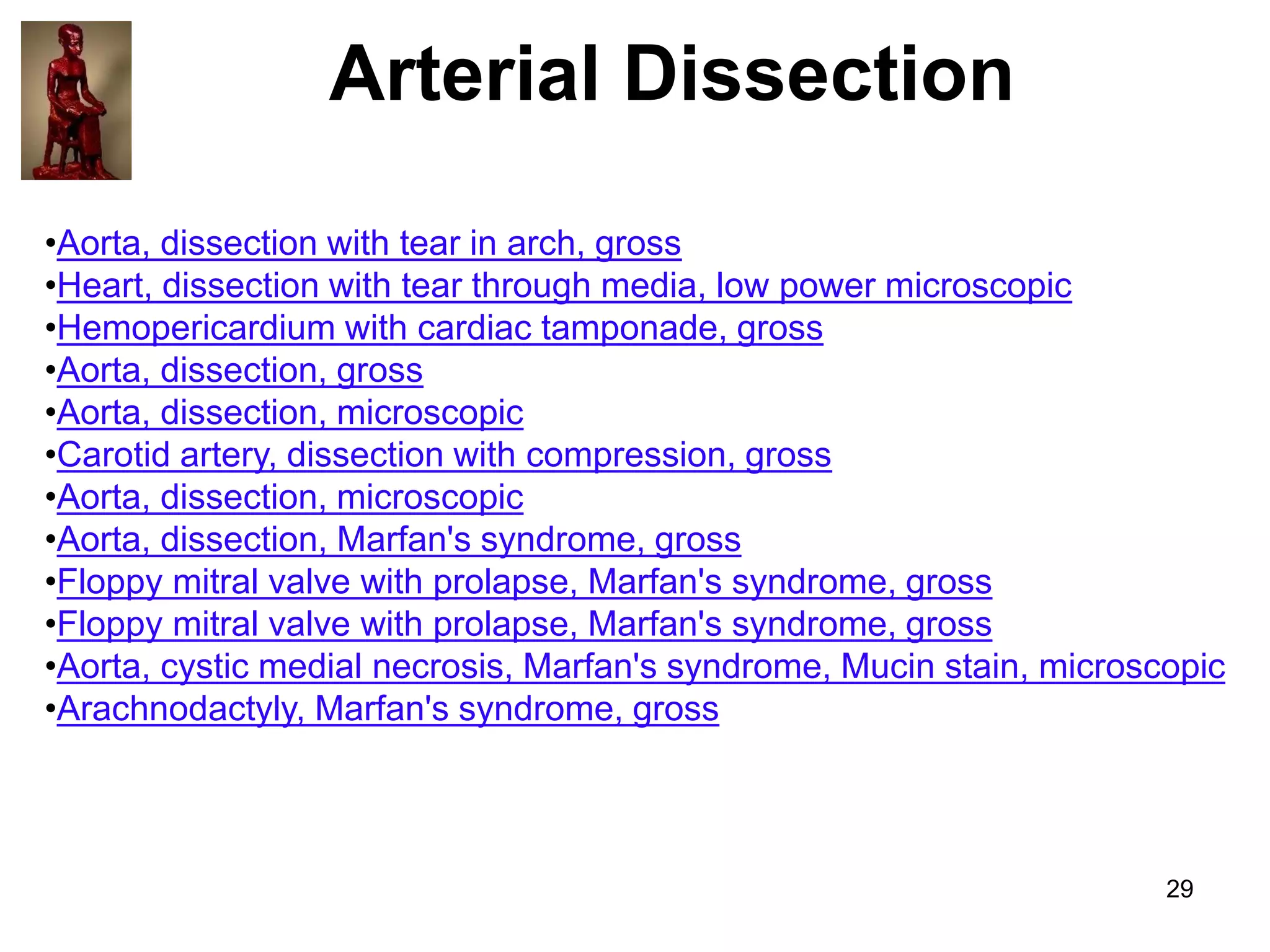 Arterial Dissection
•Aorta, dissection with tear in arch, gross
•Heart, dissection with tear through media, low power microscopic
•Hemopericardium with cardiac tamponade, gross
•Aorta, dissection, gross
•Aorta, dissection, microscopic
•Carotid artery, dissection with compression, gross
•Aorta, dissection, microscopic
•Aorta, dissection, Marfan's syndrome, gross
•Floppy mitral valve with prolapse, Marfan's syndrome, gross
•Floppy mitral valve with prolapse, Marfan's syndrome, gross
•Aorta, cystic medial necrosis, Marfan's syndrome, Mucin stain, microscopic
•Arachnodactyly, Marfan's syndrome, gross

29

 
