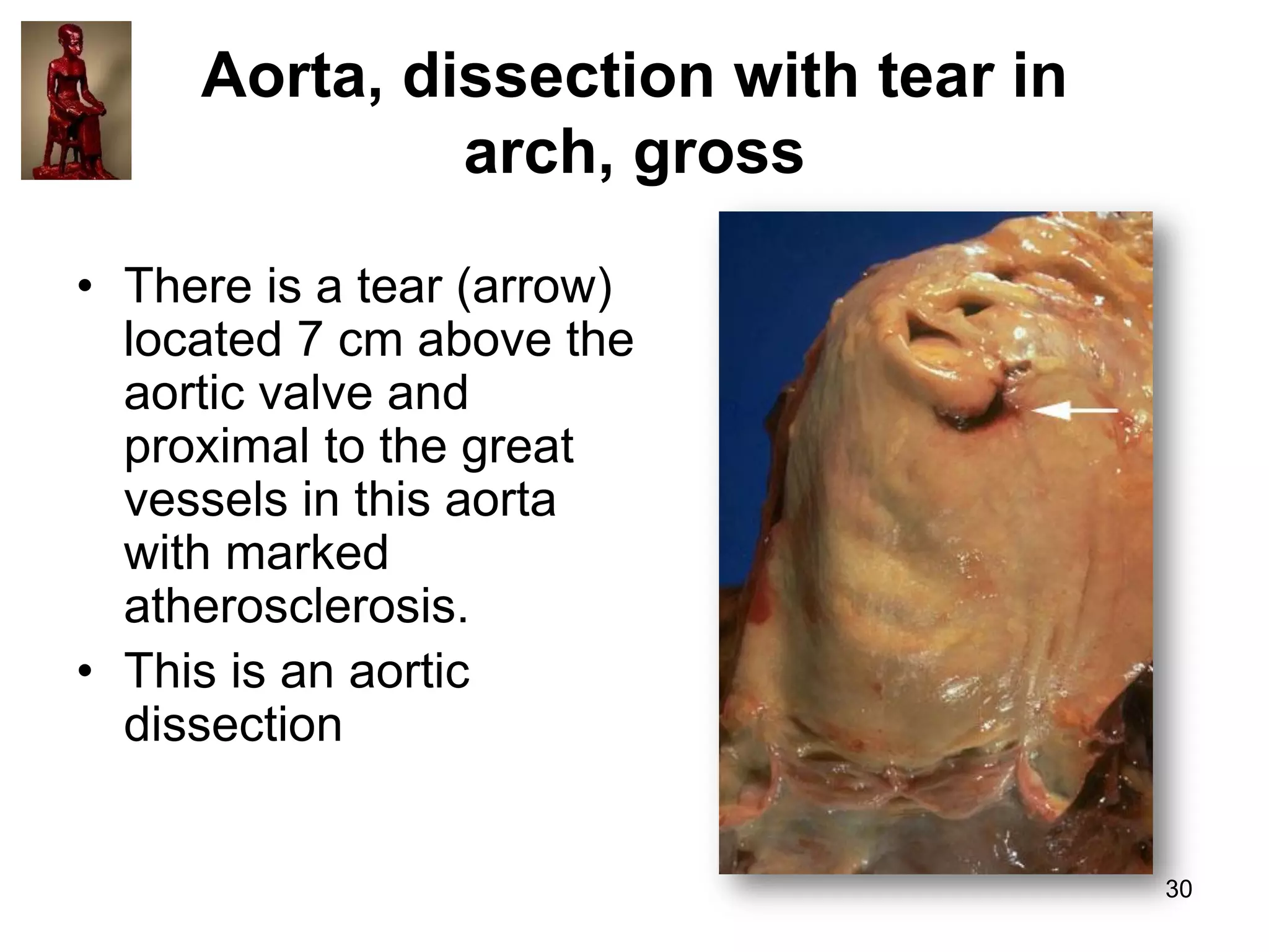 Aorta, dissection with tear in
arch, gross
• There is a tear (arrow)
located 7 cm above the
aortic valve and
proximal to the great
vessels in this aorta
with marked
atherosclerosis.
• This is an aortic
dissection

30

 