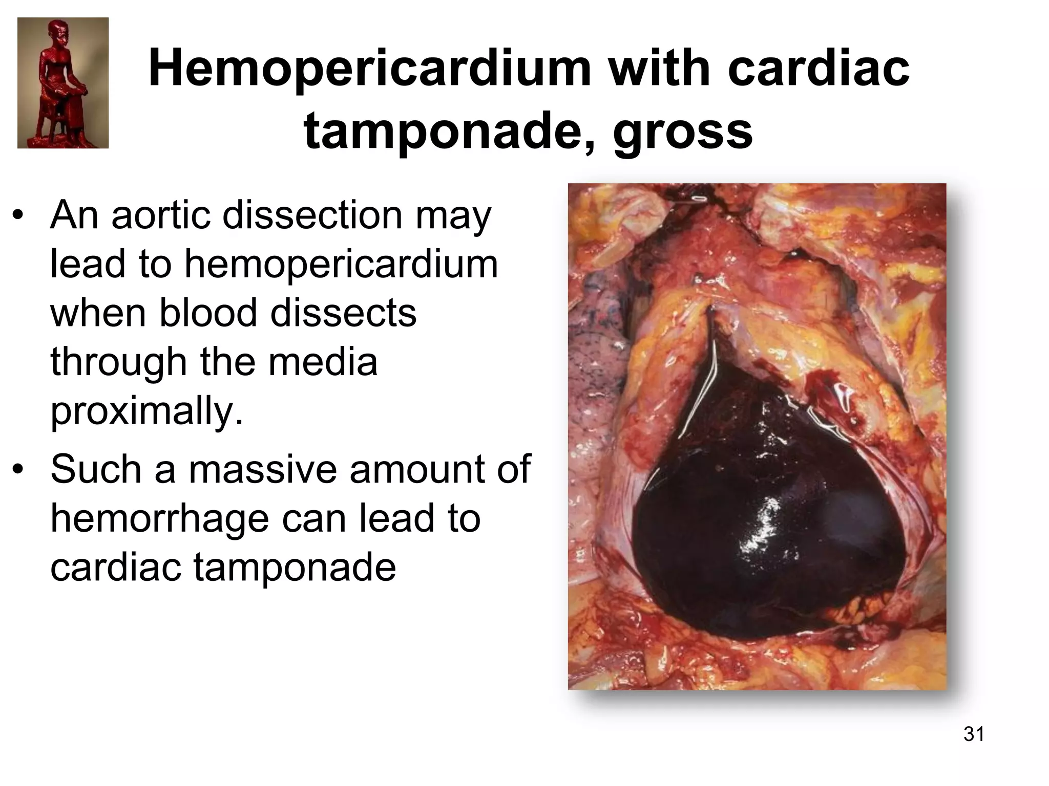 Hemopericardium with cardiac
tamponade, gross
• An aortic dissection may
lead to hemopericardium
when blood dissects
through the media
proximally.
• Such a massive amount of
hemorrhage can lead to
cardiac tamponade

31

 