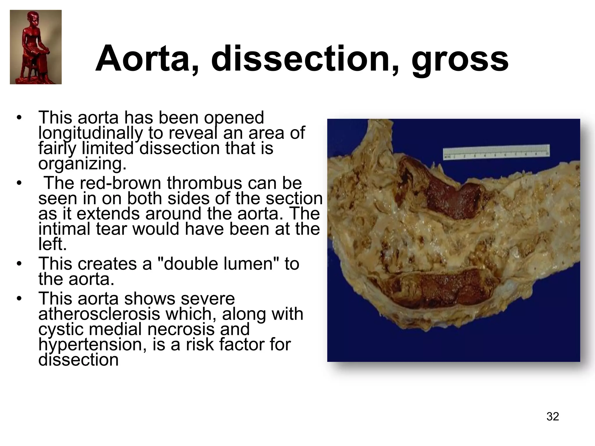 Aorta, dissection, gross
• This aorta has been opened
longitudinally to reveal an area of
fairly limited dissection that is
organizing.
• The red-brown thrombus can be
seen in on both sides of the section
as it extends around the aorta. The
intimal tear would have been at the
left.
• This creates a "double lumen" to
the aorta.
• This aorta shows severe
atherosclerosis which, along with
cystic medial necrosis and
hypertension, is a risk factor for
dissection
32

 