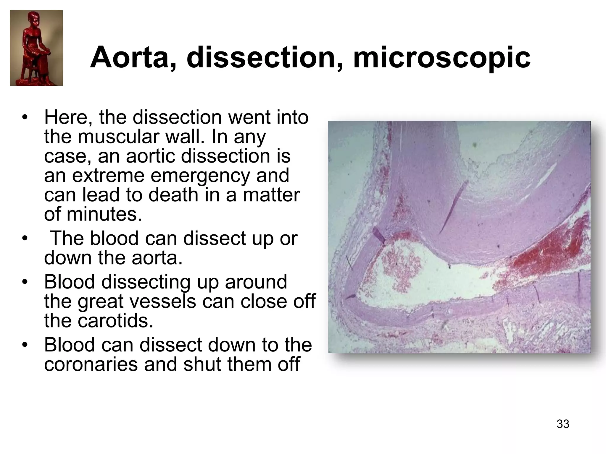 Aorta, dissection, microscopic
• Here, the dissection went into
the muscular wall. In any
case, an aortic dissection is
an extreme emergency and
can lead to death in a matter
of minutes.
• The blood can dissect up or
down the aorta.
• Blood dissecting up around
the great vessels can close off
the carotids.
• Blood can dissect down to the
coronaries and shut them off
33

 