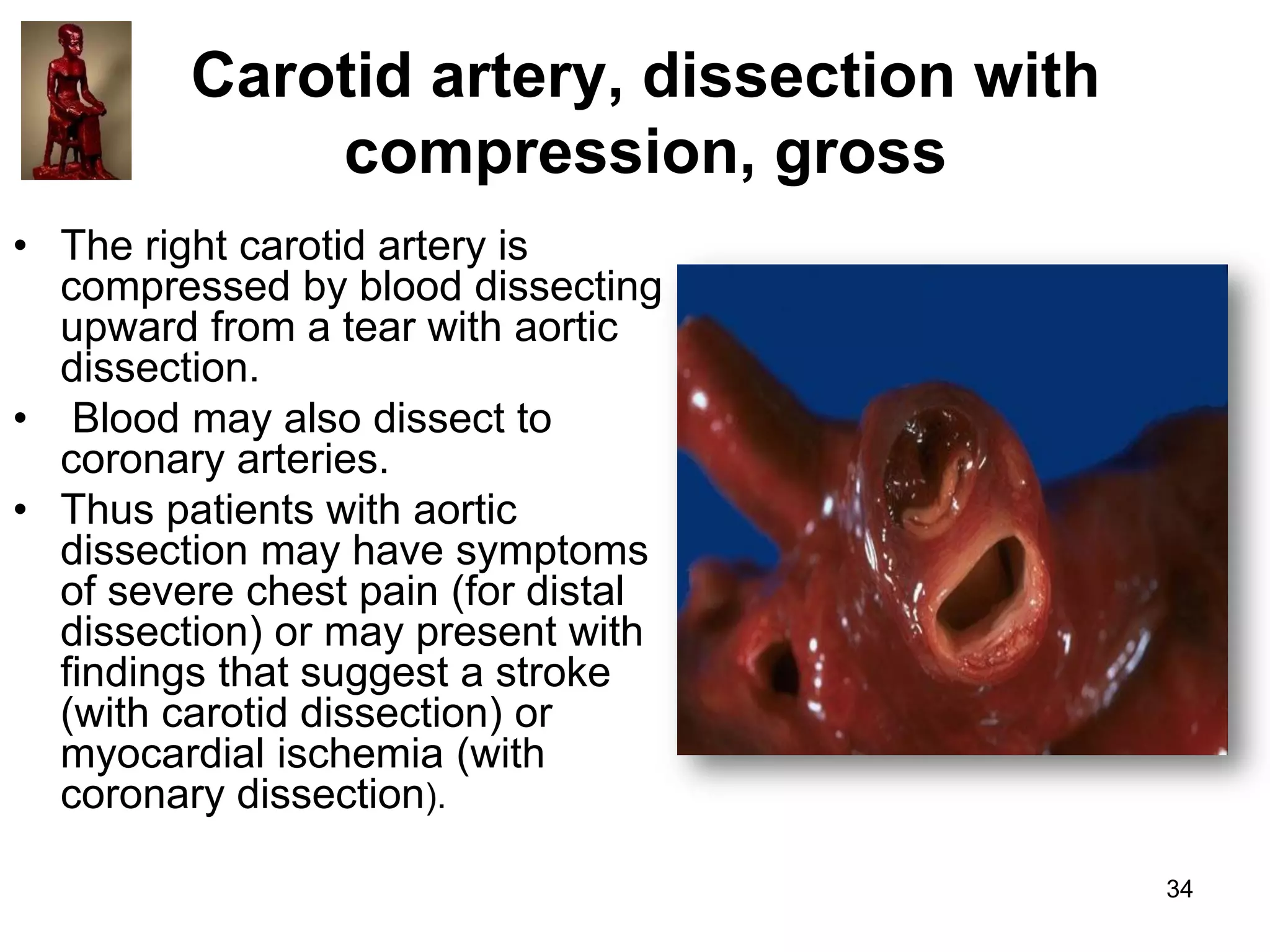 Carotid artery, dissection with
compression, gross
• The right carotid artery is
compressed by blood dissecting
upward from a tear with aortic
dissection.
• Blood may also dissect to
coronary arteries.
• Thus patients with aortic
dissection may have symptoms
of severe chest pain (for distal
dissection) or may present with
findings that suggest a stroke
(with carotid dissection) or
myocardial ischemia (with
coronary dissection).
34

 