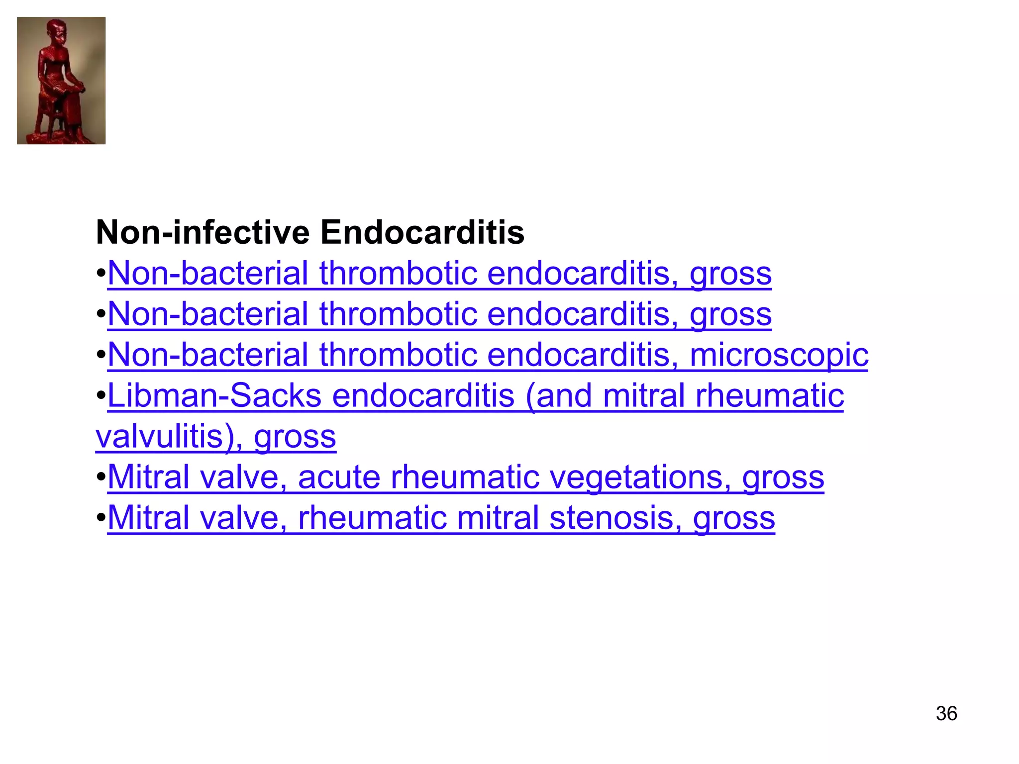 Non-infective Endocarditis
•Non-bacterial thrombotic endocarditis, gross
•Non-bacterial thrombotic endocarditis, gross
•Non-bacterial thrombotic endocarditis, microscopic
•Libman-Sacks endocarditis (and mitral rheumatic
valvulitis), gross
•Mitral valve, acute rheumatic vegetations, gross
•Mitral valve, rheumatic mitral stenosis, gross

36

 