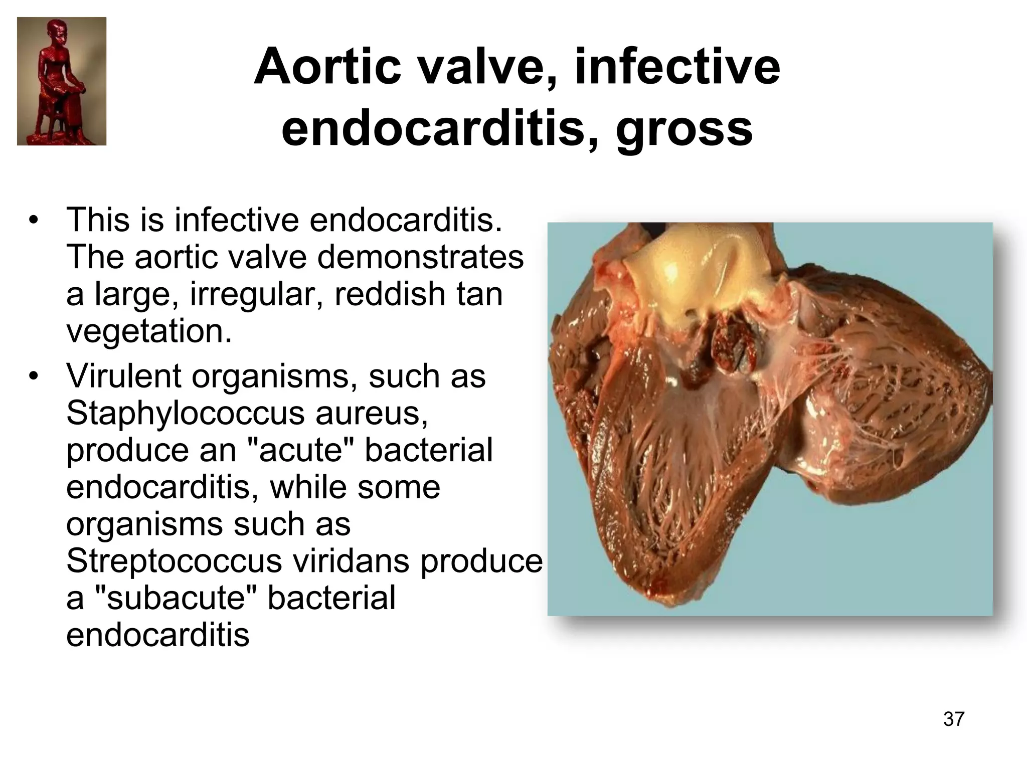 Aortic valve, infective
endocarditis, gross
• This is infective endocarditis.
The aortic valve demonstrates
a large, irregular, reddish tan
vegetation.
• Virulent organisms, such as
Staphylococcus aureus,
produce an "acute" bacterial
endocarditis, while some
organisms such as
Streptococcus viridans produce
a "subacute" bacterial
endocarditis
37

 