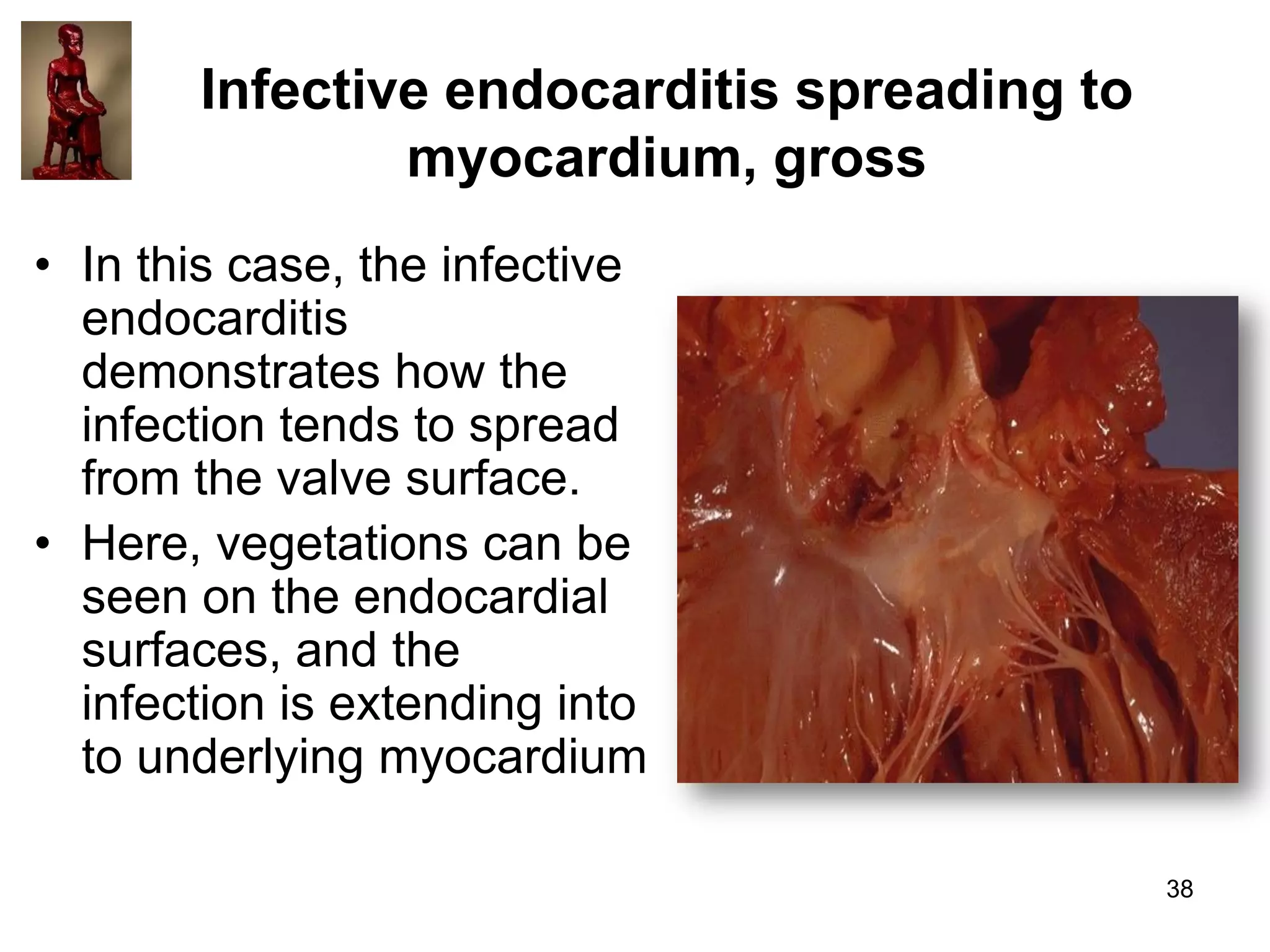 Infective endocarditis spreading to
myocardium, gross
• In this case, the infective
endocarditis
demonstrates how the
infection tends to spread
from the valve surface.
• Here, vegetations can be
seen on the endocardial
surfaces, and the
infection is extending into
to underlying myocardium
38

 