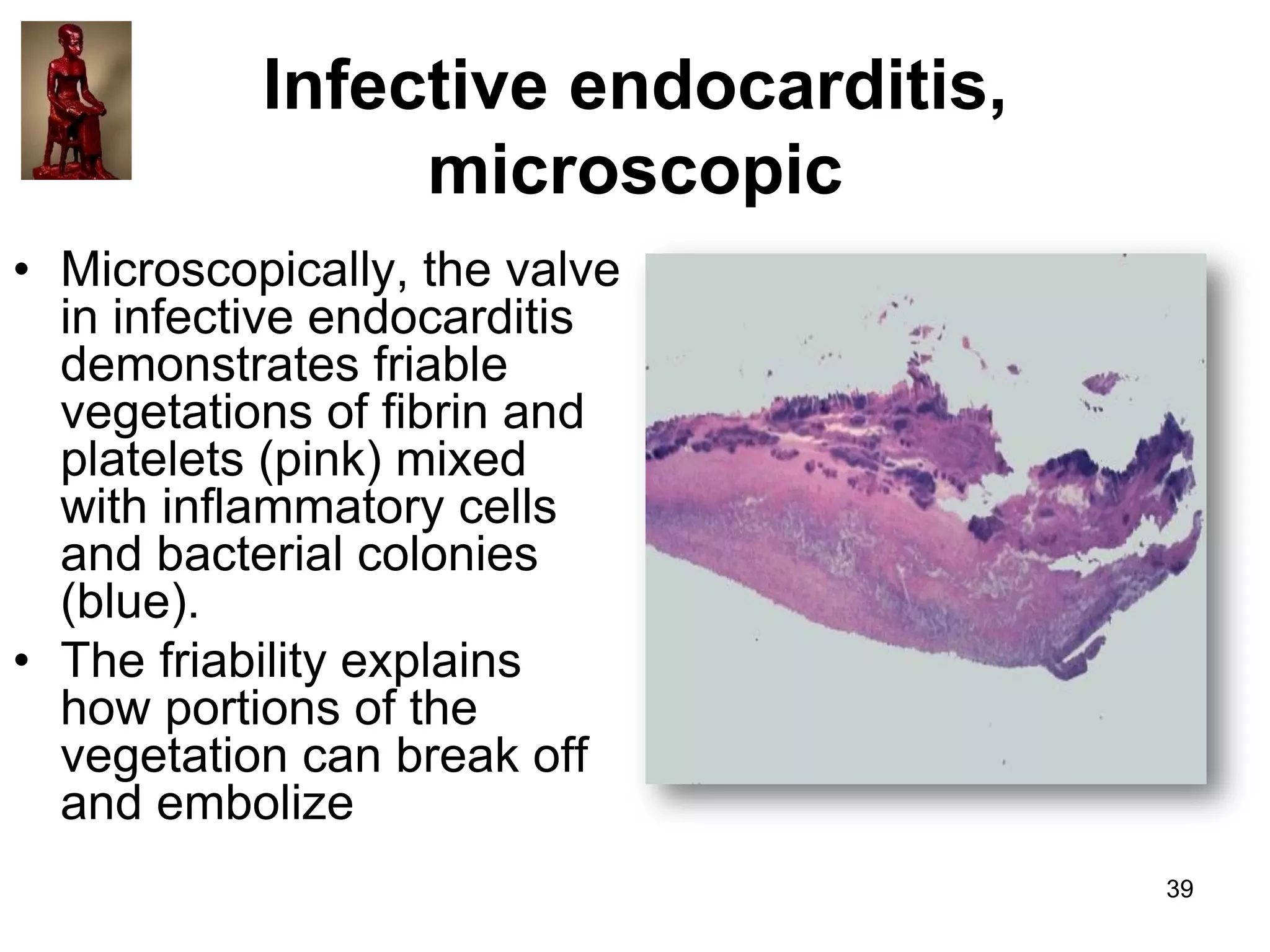 Infective endocarditis,
microscopic
• Microscopically, the valve
in infective endocarditis
demonstrates friable
vegetations of fibrin and
platelets (pink) mixed
with inflammatory cells
and bacterial colonies
(blue).
• The friability explains
how portions of the
vegetation can break off
and embolize
39

 