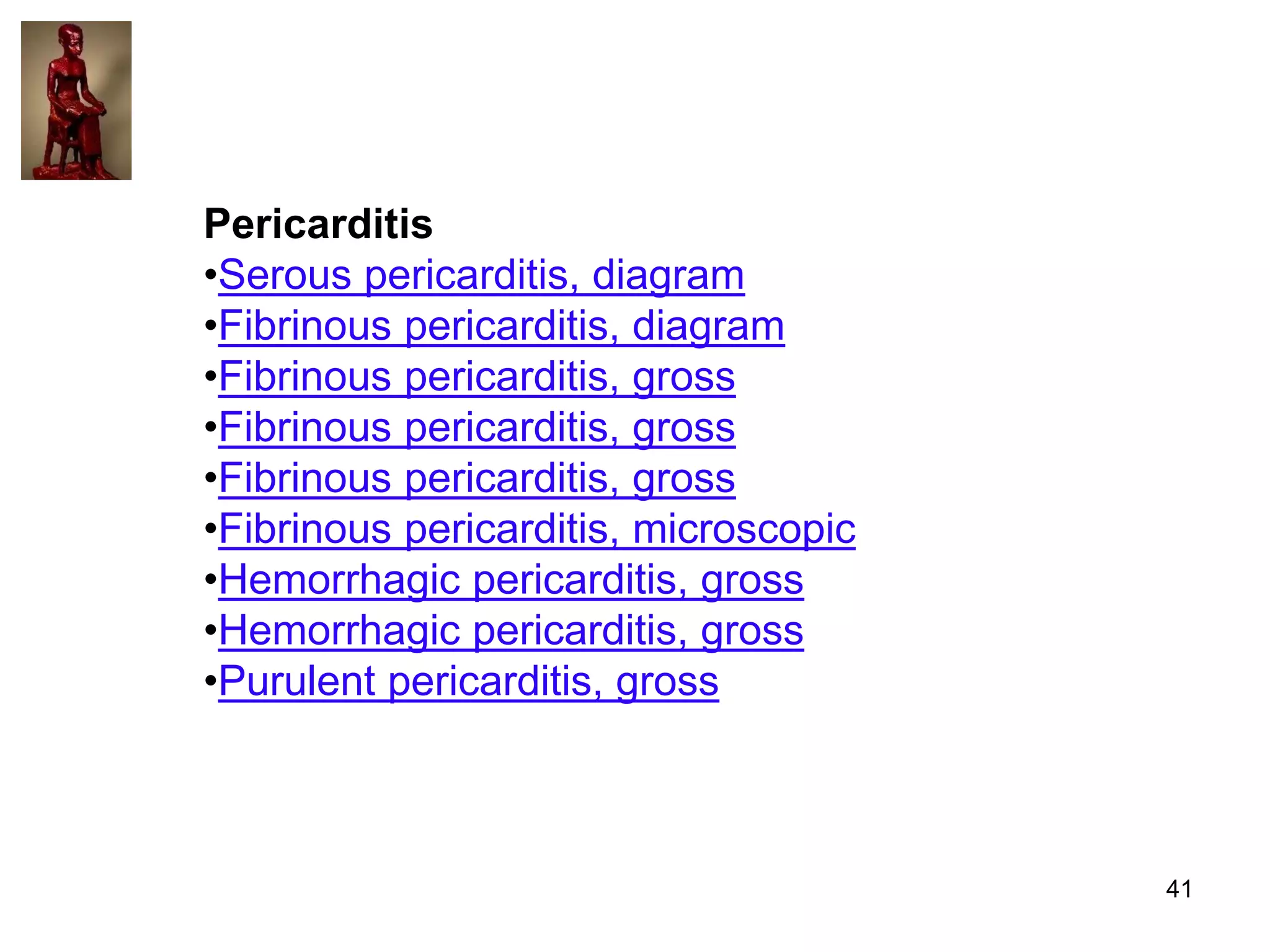 Pericarditis
•Serous pericarditis, diagram
•Fibrinous pericarditis, diagram
•Fibrinous pericarditis, gross
•Fibrinous pericarditis, gross
•Fibrinous pericarditis, gross
•Fibrinous pericarditis, microscopic
•Hemorrhagic pericarditis, gross
•Hemorrhagic pericarditis, gross
•Purulent pericarditis, gross

41

 