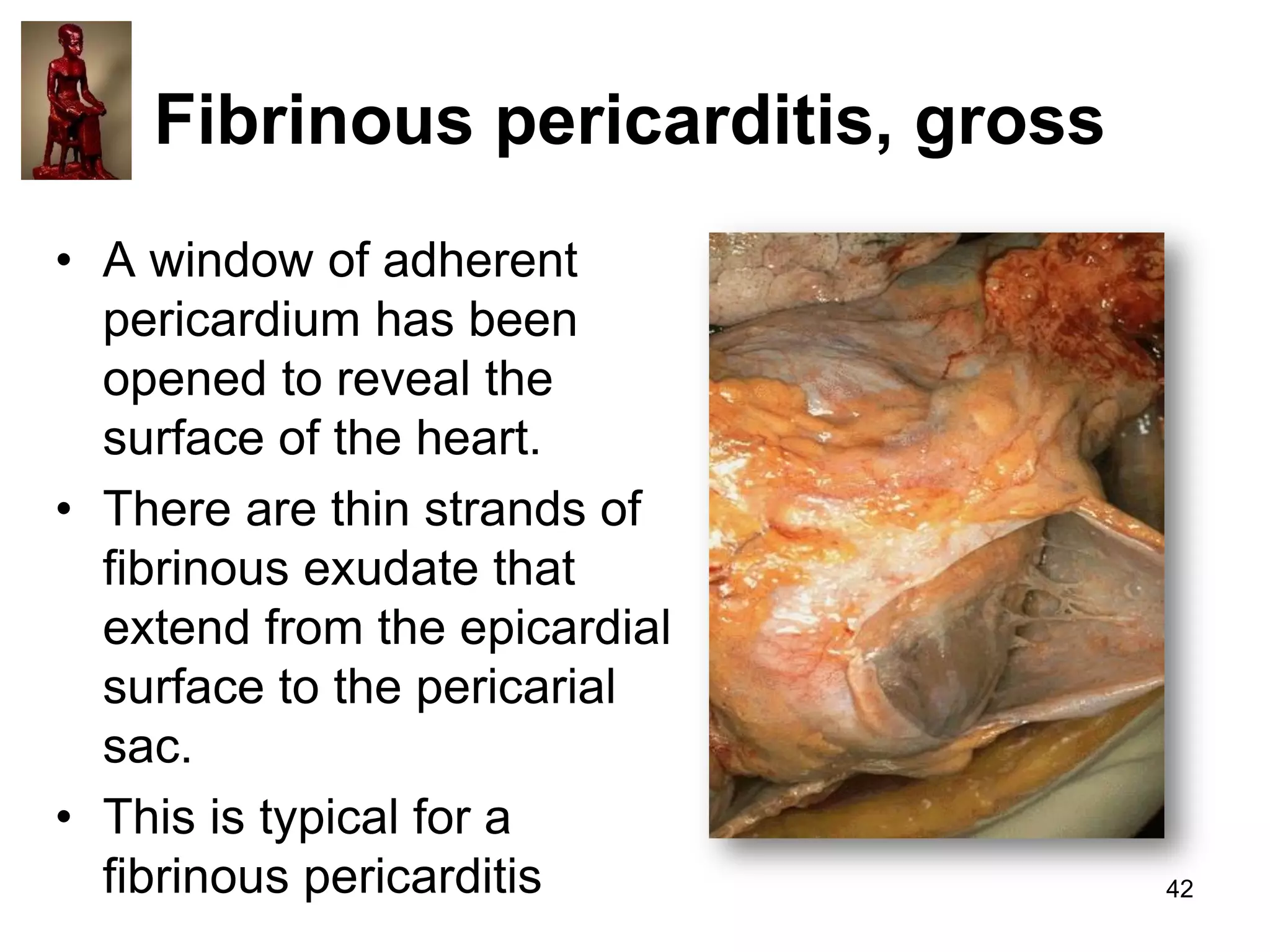 Fibrinous pericarditis, gross
• A window of adherent
pericardium has been
opened to reveal the
surface of the heart.
• There are thin strands of
fibrinous exudate that
extend from the epicardial
surface to the pericarial
sac.
• This is typical for a
fibrinous pericarditis

42

 