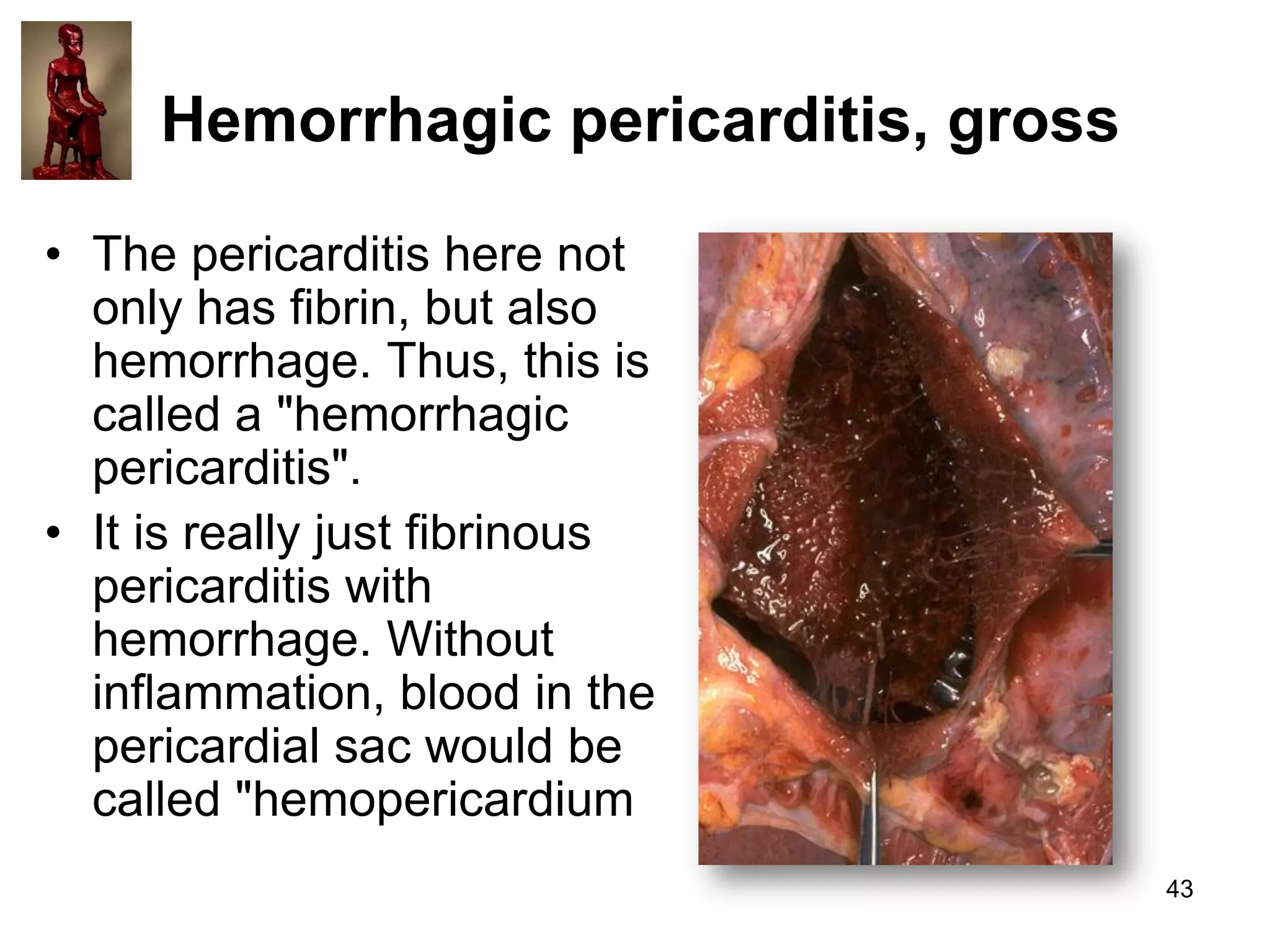 Hemorrhagic pericarditis, gross
• The pericarditis here not
only has fibrin, but also
hemorrhage. Thus, this is
called a "hemorrhagic
pericarditis".
• It is really just fibrinous
pericarditis with
hemorrhage. Without
inflammation, blood in the
pericardial sac would be
called "hemopericardium
43

 