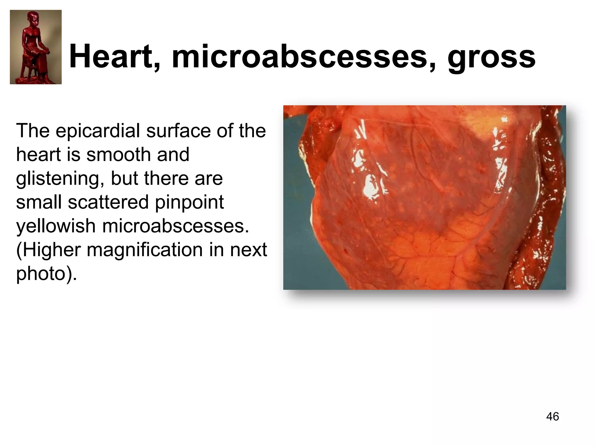 Heart, microabscesses, gross
The epicardial surface of the
heart is smooth and
glistening, but there are
small scattered pinpoint
yellowish microabscesses.
(Higher magnification in next
photo).

46

 