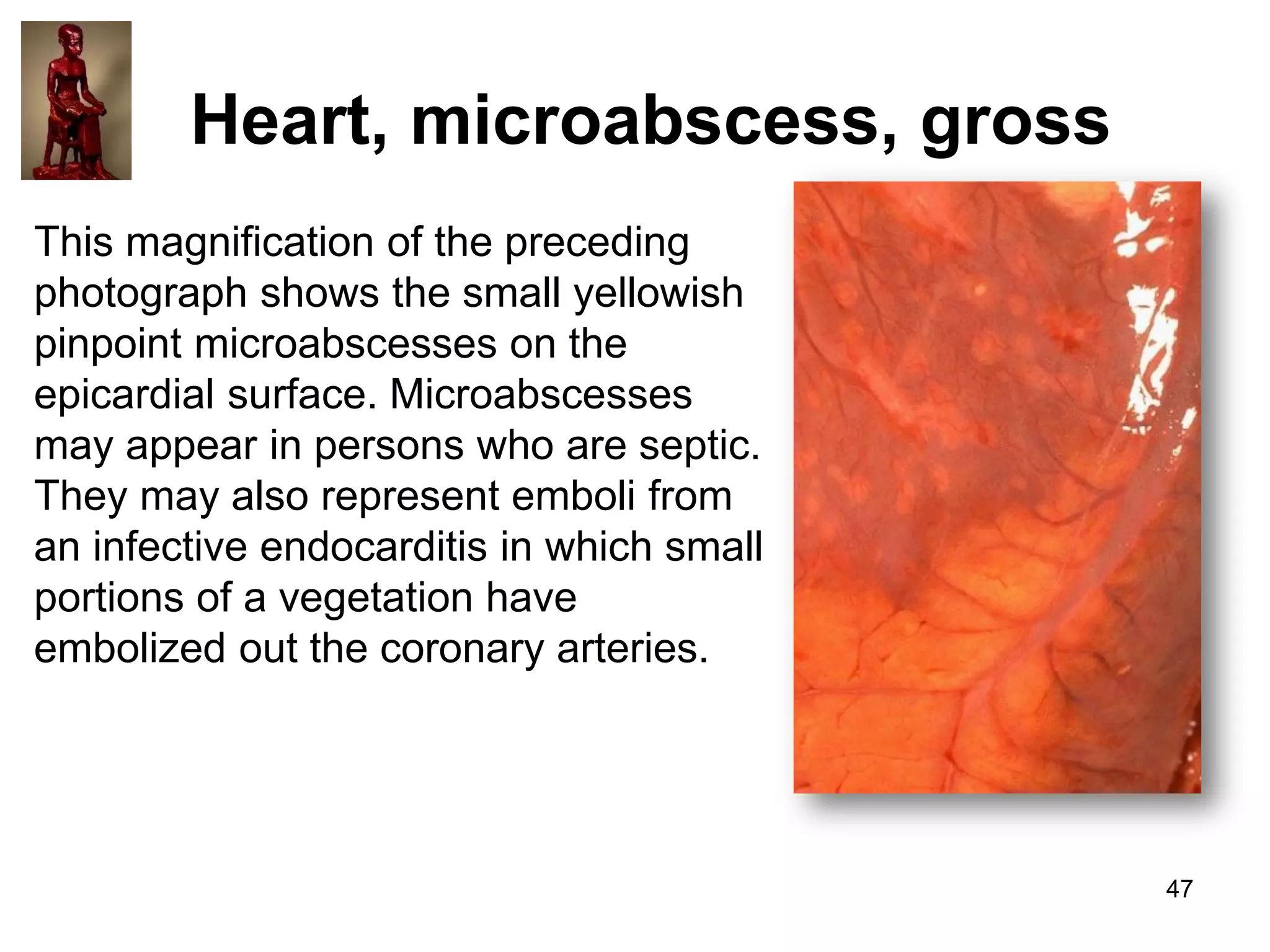Heart, microabscess, gross
This magnification of the preceding
photograph shows the small yellowish
pinpoint microabscesses on the
epicardial surface. Microabscesses
may appear in persons who are septic.
They may also represent emboli from
an infective endocarditis in which small
portions of a vegetation have
embolized out the coronary arteries.

47

 