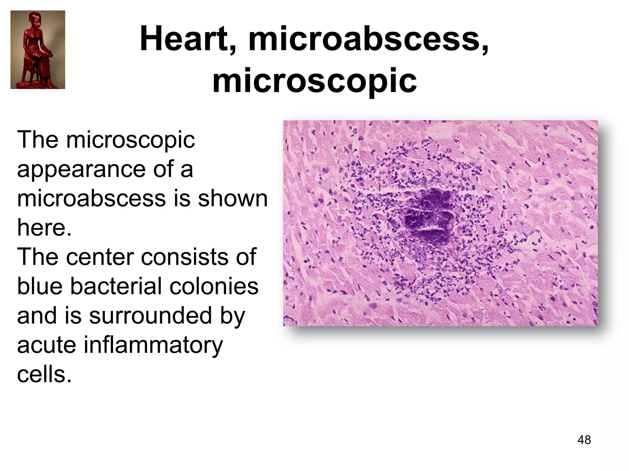 Heart, microabscess,
microscopic
The microscopic
appearance of a
microabscess is shown
here.
The center consists of
blue bacterial colonies
and is surrounded by
acute inflammatory
cells.
48

 