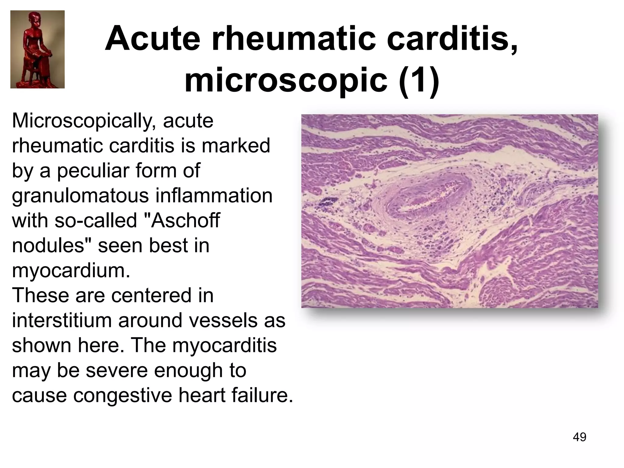Acute rheumatic carditis,
microscopic (1)
Microscopically, acute
rheumatic carditis is marked
by a peculiar form of
granulomatous inflammation
with so-called "Aschoff
nodules" seen best in
myocardium.
These are centered in
interstitium around vessels as
shown here. The myocarditis
may be severe enough to
cause congestive heart failure.
49

 